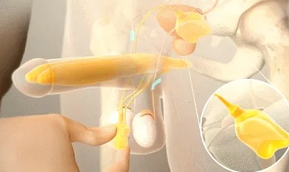 【渭南益健男科医院】包皮垢是如何形成的(图1)